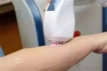脱毛