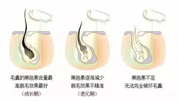 脱毛