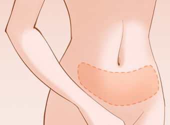 腹部吸脂