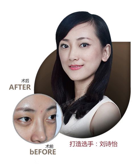 埋线双眼皮有什么优点吗