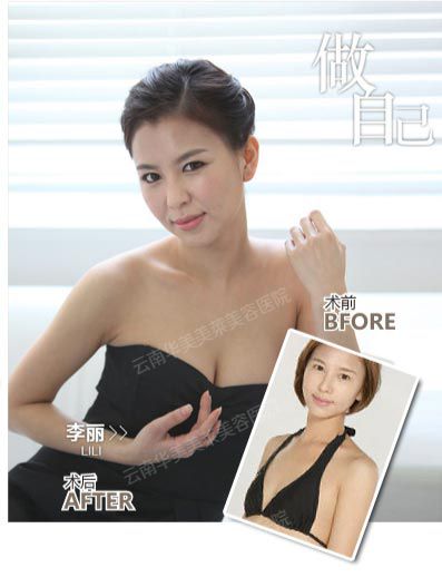假体丰胸