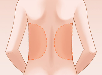 腰部吸脂