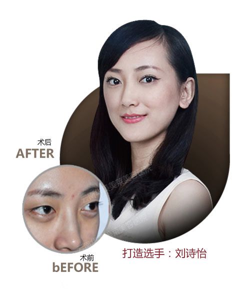 昆明双眼皮手术适合哪些人