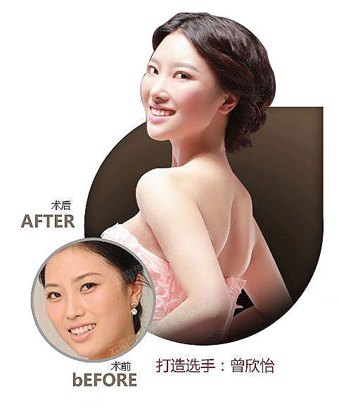 埋线双眼皮