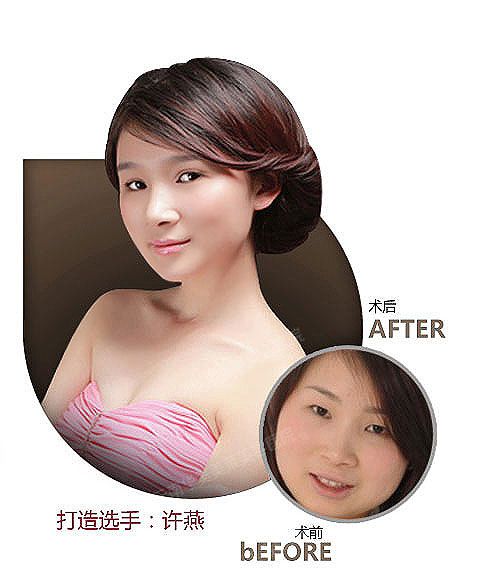 韩式双眼皮