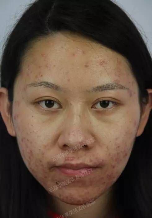 ▶视频丨央视大专辩论赛女辩手 三年“无脸见人”的元凶是