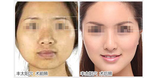 丰太阳穴方法