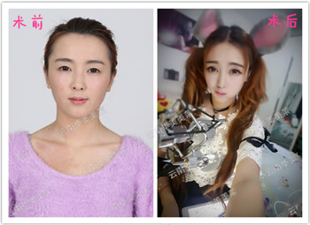 暑假学生整形