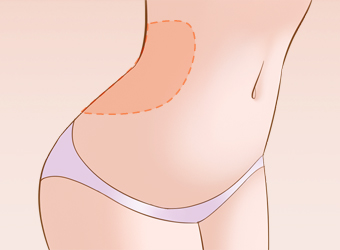 腰腹吸脂需要多少钱？